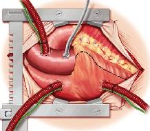 Dramatic reduction in pain