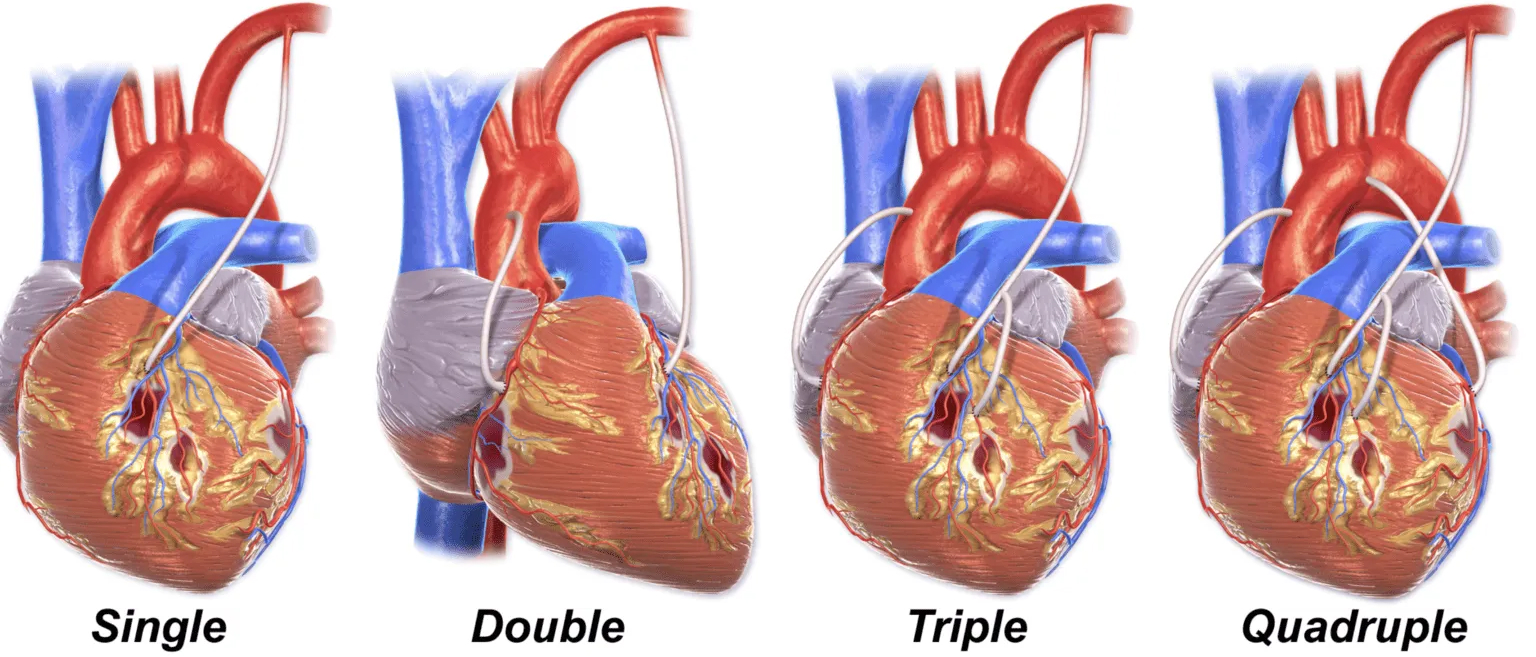 Minimal invasive bypass surgery in Bangalore