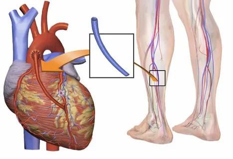 Aortic Valve Replacement