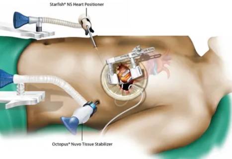 Midcab Surgery Bangalore