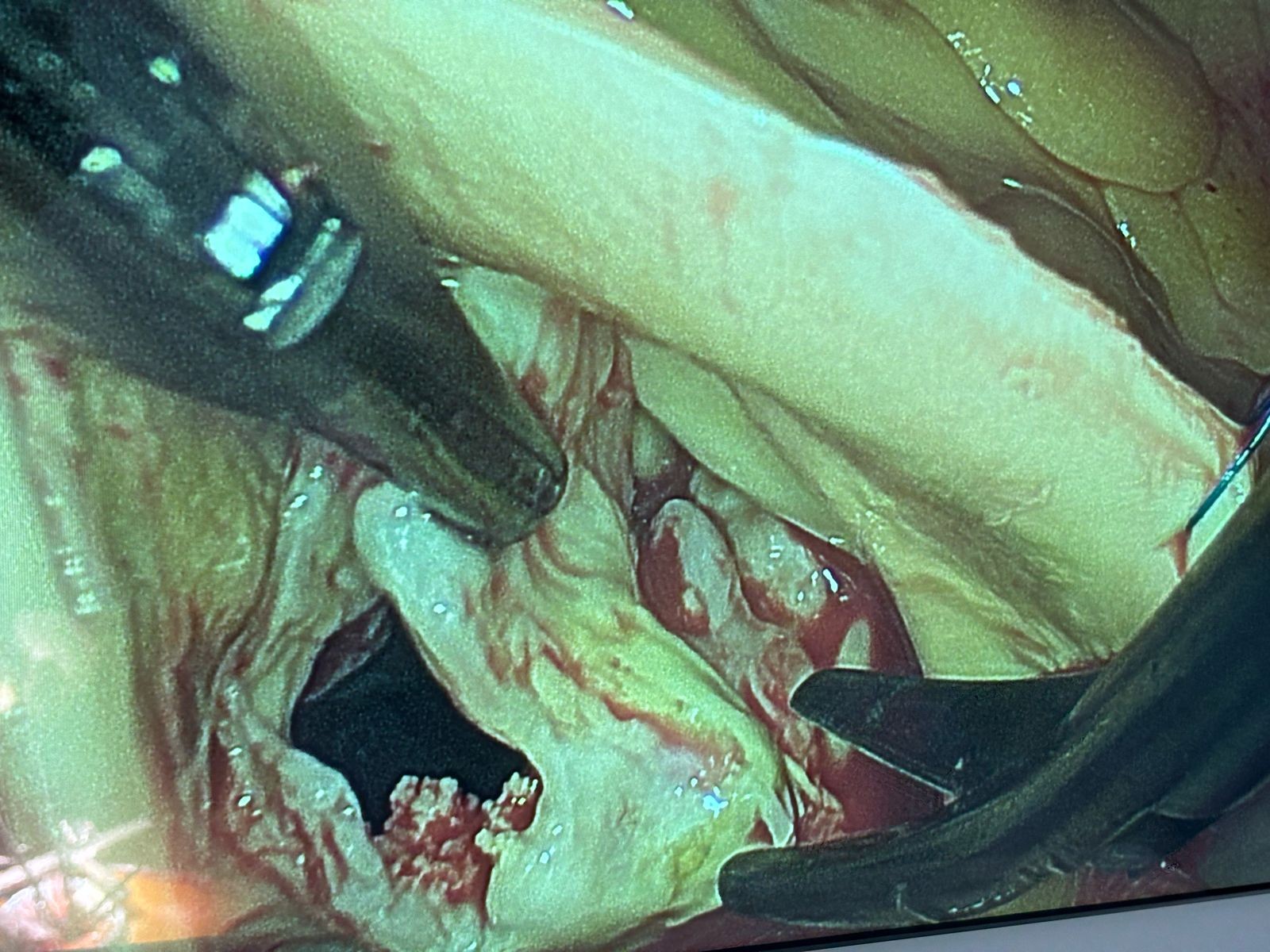 Endoscopic Aortic Valve replacement